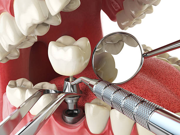 Best Emergency Dentist for Lost Fillings or Crowns in Dunlap, IL